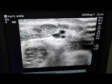 Embedded thumbnail for RaFeVA in neonato