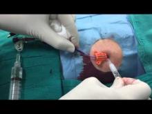 Embedded thumbnail for Fissaggio ideale di un PICC: Securacath + colla + medicazione trasparente 